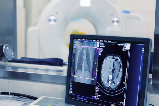 How to Diagnose Lung Cancer with a CT Scan